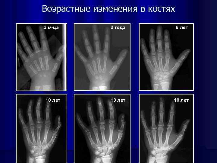 Возрастные изменения в костях 3 м-ца 10 лет 3 года 6 лет 13 лет