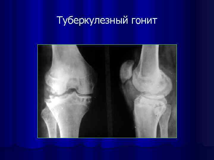 Коленный туберкулез. Туберкулез коленного сустава 2-я стадия рентген. Туберкулез коленного сустава 2 стадия рентген. Туберкулез кости коленного сустава. Туберкулезный артрит коленного сустава.