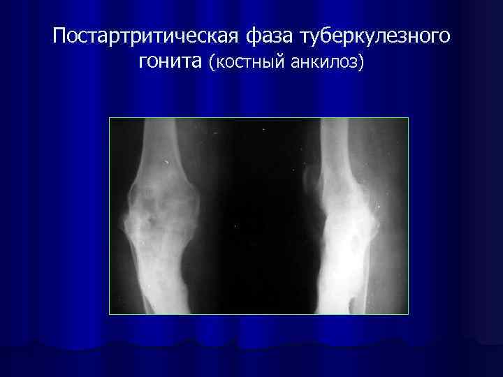 Коленный туберкулез. Костный туберкулез коленного сустава. Туберкулез суставов рентген. Туберкулез коленного сустава рентген.