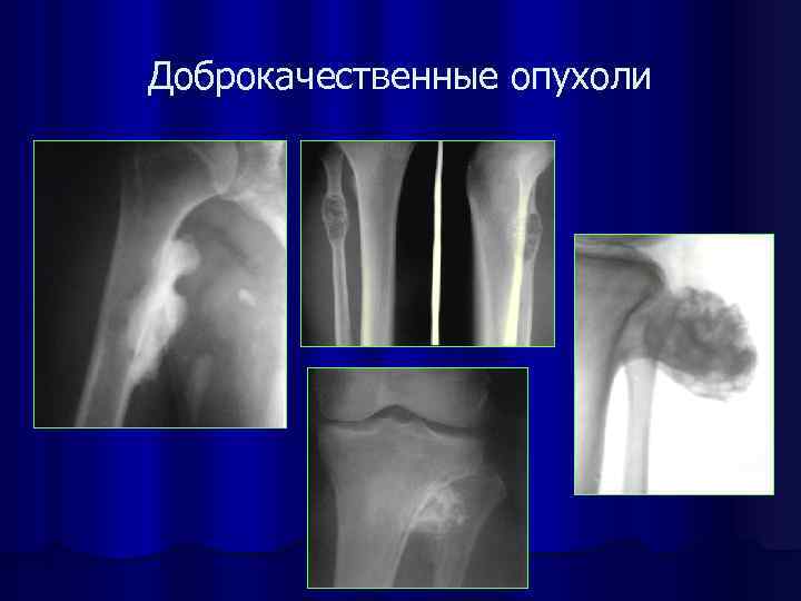 Костный отек. Доброкачественные опухоли костей диагностика. Доброкачественная опухоль кости рентген. Фиброма головки бедренной кости. Доброкачественная опухоль бедренной кости.