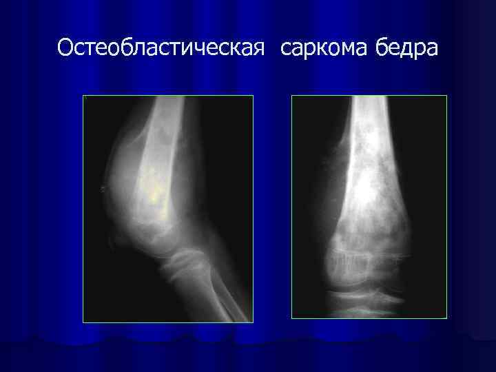 Саркома кости. Остеосаркома бедренной кости рентгенограмма. Остеогенная саркома остеобластическая форма. Остеосаркома бедренной кости рентген.