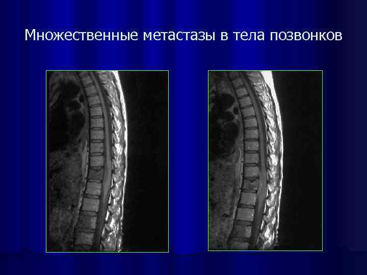 Метастазы в позвоночник прогноз жизни. Метастазы в позвоночнике рентген. Метастазы позвонков мрт.