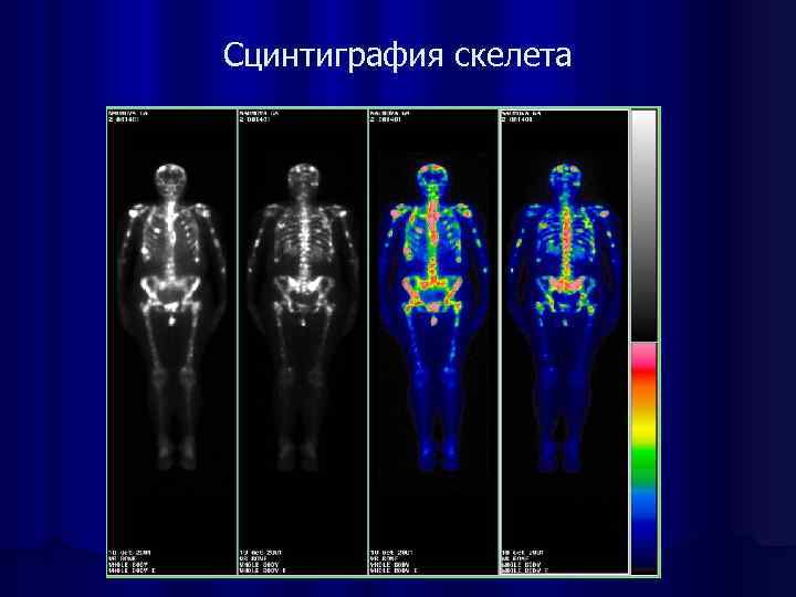 Сцинтиграфия скелета 