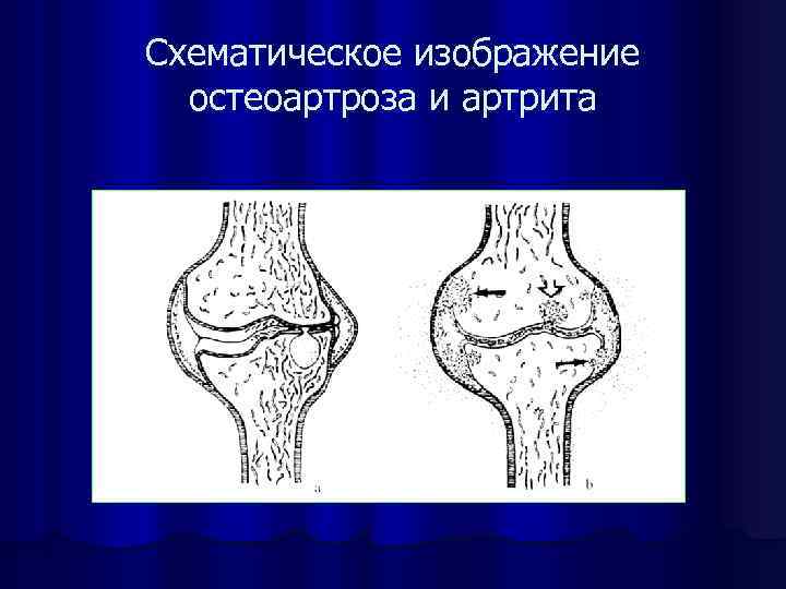 Схематическое изображение остеоартроза и артрита 