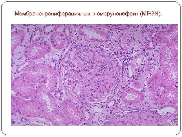 Мембранопролиферациялық гломерулонефрит (MPGN). 