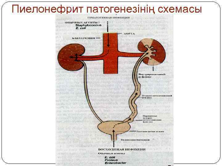 Пиелонефрит патогенезінің схемасы 