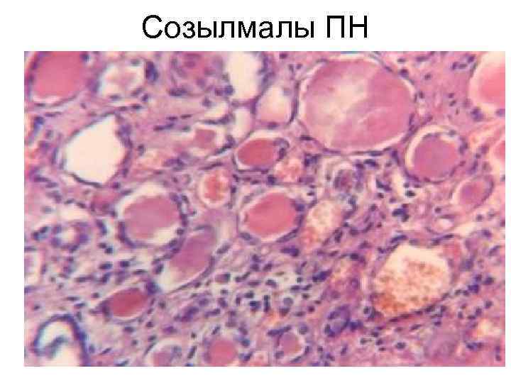 Созылмалы ПН 