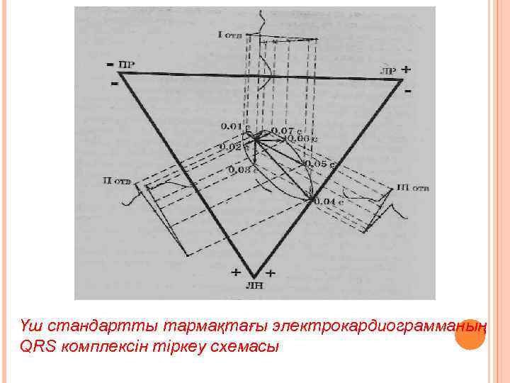 Үш стандартты тармақтағы электрокардиограмманың QRS комплексін тіркеу схемасы 