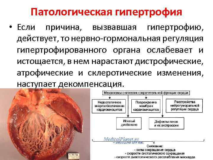 Патологическая гипертрофия • Если причина, вызвавшая гипертрофию, действует, то нервно гормональная регуляция гипертрофированного органа