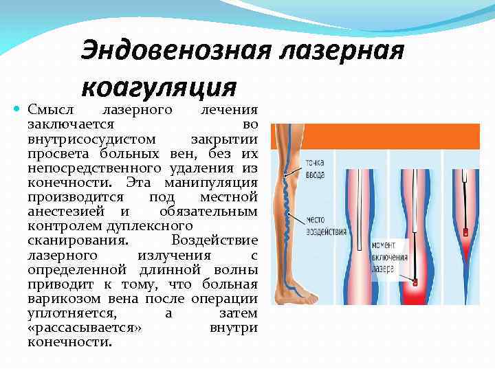 Коагуляция вен. Эндовазальная лазерная вен. Эндовазальной лазерной коагуляцией вен. Лазерная коагуляция варикозных вен.