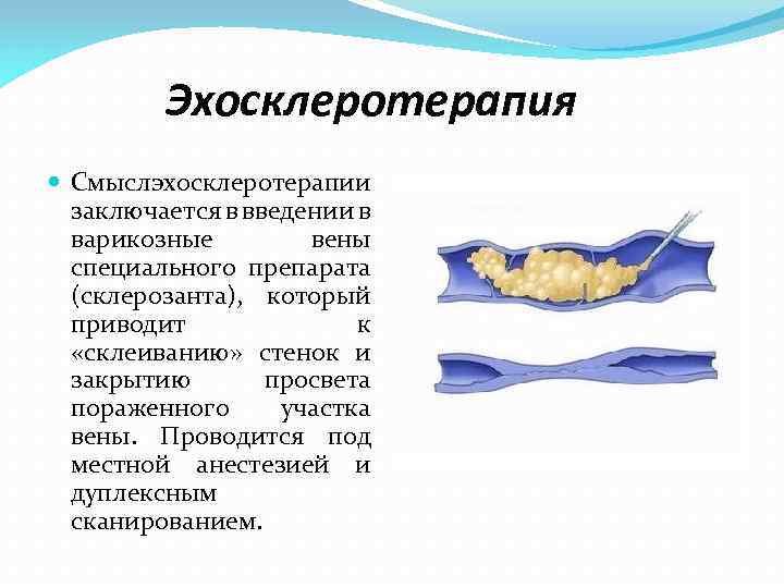 Эхосклеротерапия Смысл хосклеротерапии э заключается в введении в варикозные вены специального препарата (склерозанта), который