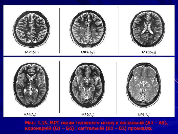 Мал. 1. 15. МРТ скани головного мозку в аксіальній (А 1 – А 9),