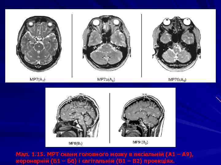 Мал. 1. 15. МРТ скани головного мозку в аксіальній (А 1 – А 9),