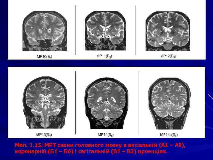 Мал. 1. 15. МРТ скани головного мозку в аксіальній (А 1 – А 9),