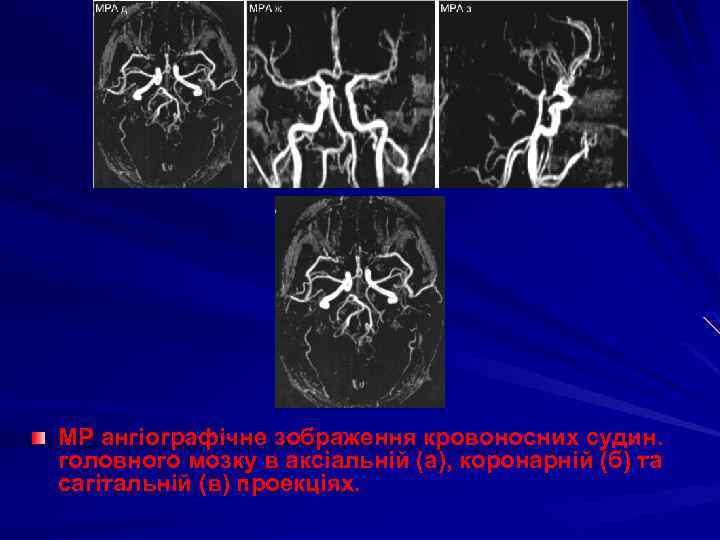 МР ангіографічне зображення кровоносних судин. головного мозку в аксіальній (а), коронарній (б) та сагітальній