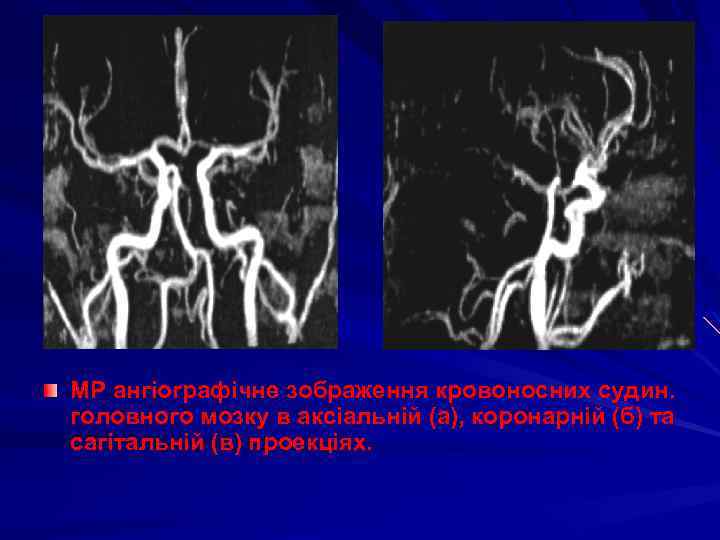 МР ангіографічне зображення кровоносних судин. головного мозку в аксіальній (а), коронарній (б) та сагітальній