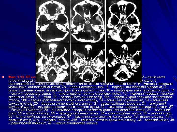 Мал. 1. 13. КТ скани черепа в аксіальній площині. 1 – клиноподібне підвищення, 2