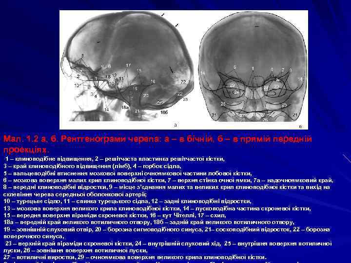 Мал. 1. 2 а, б. Рентгенограми черепа: а – в бічній, б – в