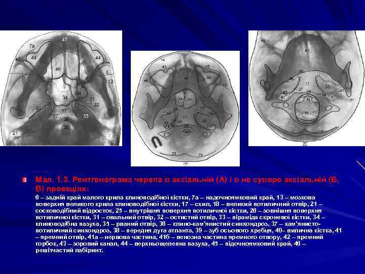 Мал. 1. 3. Рентгенограма черепа в аксіальній (А) і в не суворо аксіальній (Б,