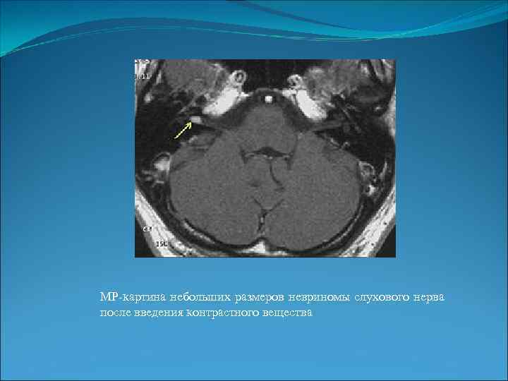 МР-картина небольших размеров невриномы слухового нерва после введения контрастного вещества 