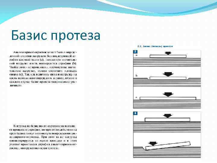 Базис протеза 