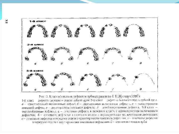 Классификация дефектов зубных рядов