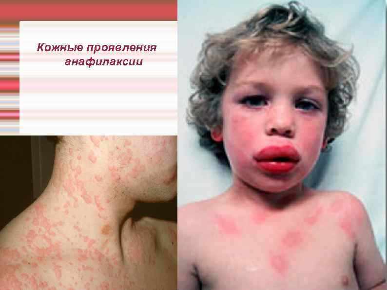 Кожные проявления анафилаксии 