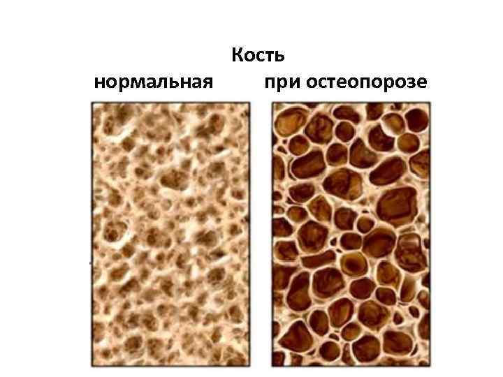 Кость нормальная при остеопорозе 