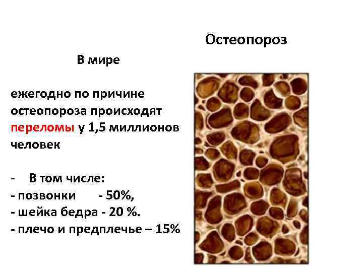 Плотный часто. Остеопороз презентация. Остеопороз статистика. Остеопороз статистика в мире. Остеопороз статистика заболевания.