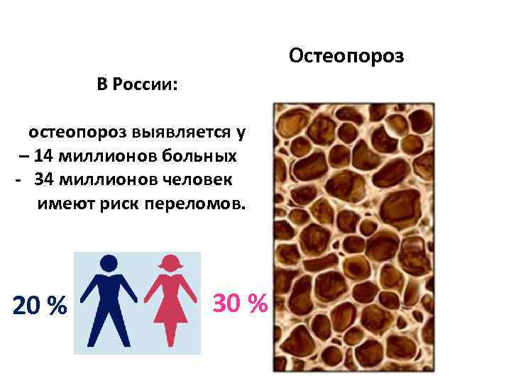 Остеопороз у детей презентация