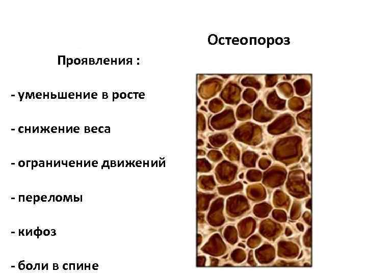 Остеопороз Проявления : - уменьшение в росте - снижение веса - ограничение движений -