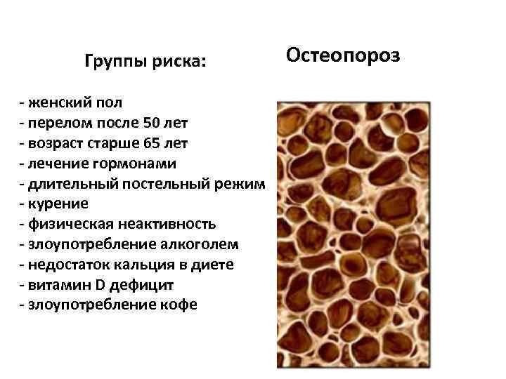 Группы риска: - женский пол - перелом после 50 лет - возраст старше 65