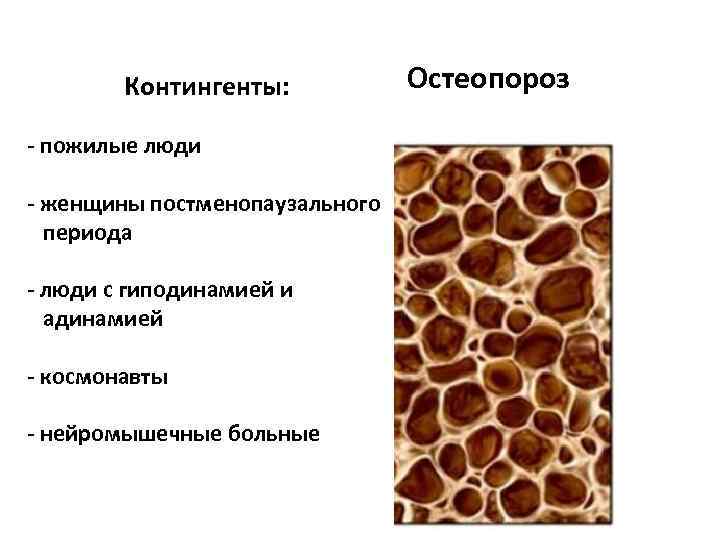 Презентация по теме остеопороз