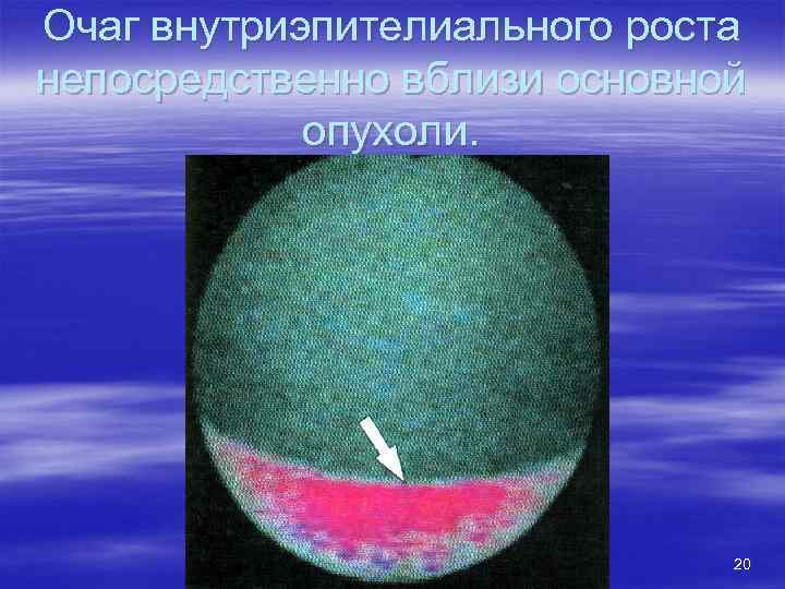 Очаг внутриэпителиального роста непосредственно вблизи основной опухоли. 20 