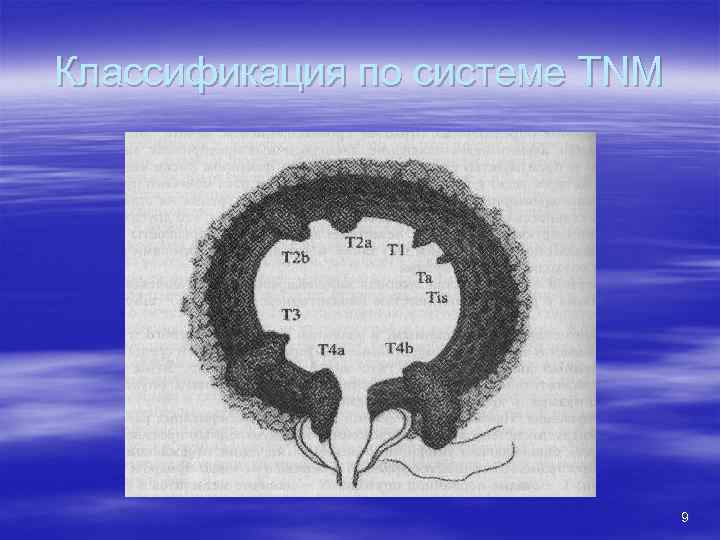 Классификация по системе TNM 9 