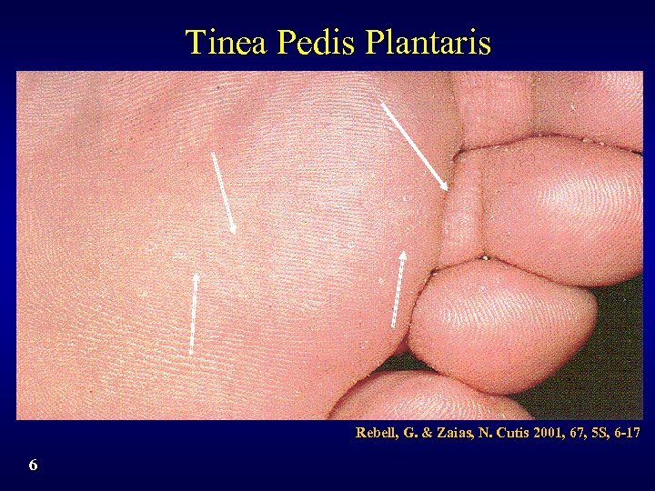 Tinea Pedis Plantaris Rebell, G. & Zaias, N. Cutis 2001, 67, 5 S, 6