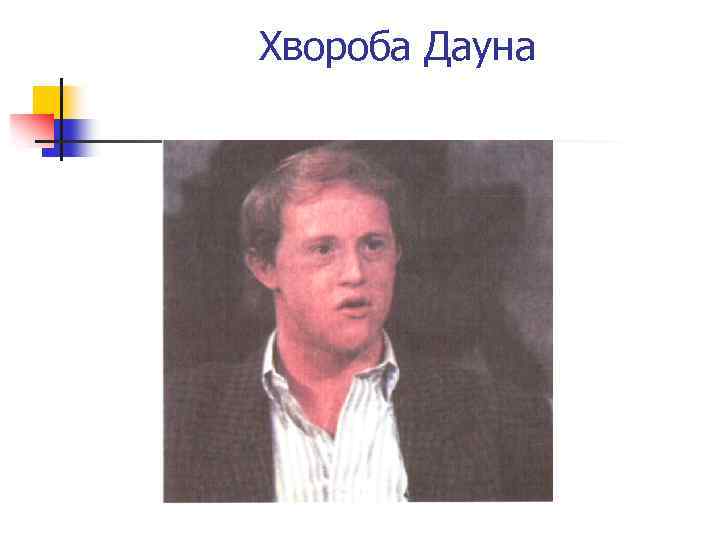 Хвороба Дауна 