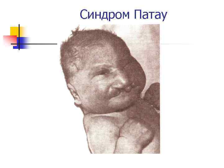 Синдром Патау 