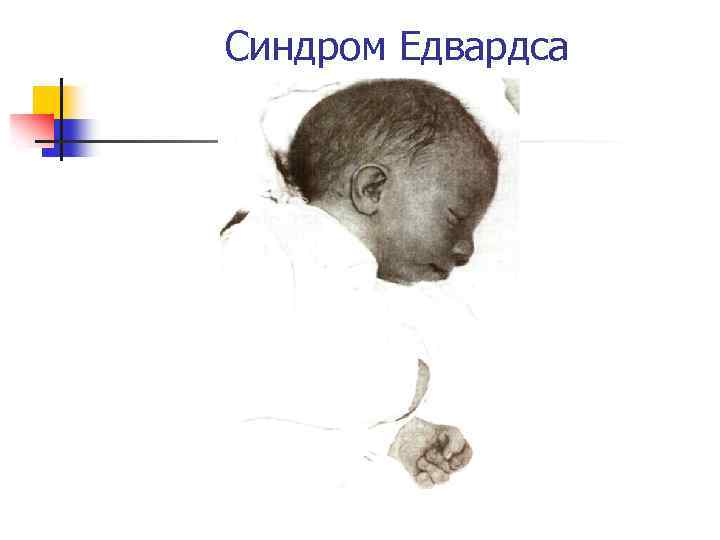 Синдром Едвардса 