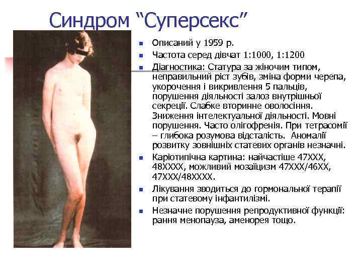 Синдром “Суперсекс” n n n Описаний у 1959 р. Частота серед дівчат 1: 1000,