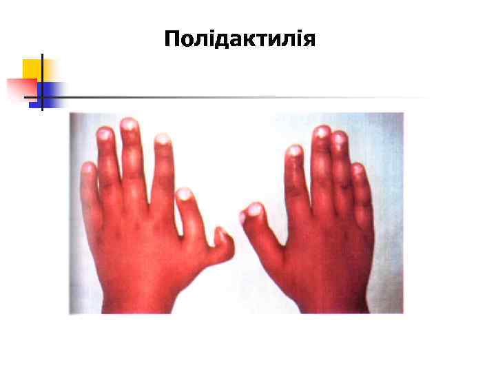 Полідактилія 