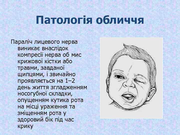 Патологія обличчя Параліч лицевого нерва виникає внаслідок компресії нерва об мис крижової кістки або