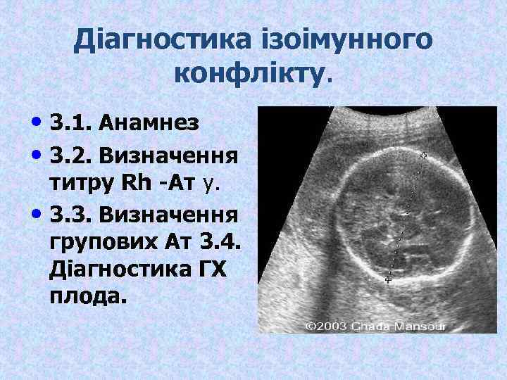 Діагностика ізоімунного конфлікту. • 3. 1. Анамнез • 3. 2. Визначення титру Rh -Ат