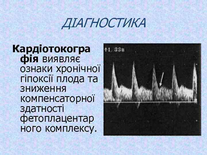 ДІАГНОСТИКА Кардіотокогра фія виявляє ознаки хронічної гіпоксії плода та зниження компенсаторної здатності фетоплацентар ного