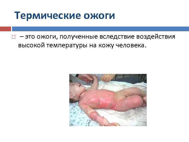 Термические ожоги – это ожоги, полученные вследствие воздействия высокой температуры на кожу человека. 