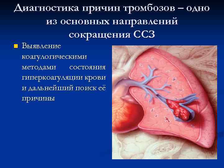 Диагностика причин тромбозов – одно из основных направлений сокращения ССЗ n Выявление коагулогическими методами