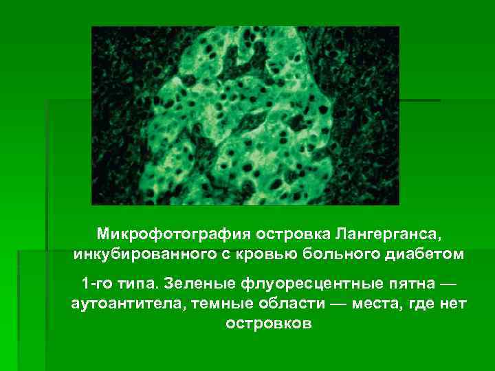 Микрофотография островка Лангерганса, инкубированного с кровью больного диабетом 1 -го типа. Зеленые флуоресцентные пятна