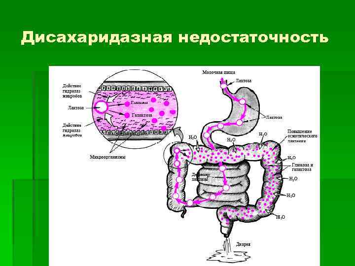 Дисахаридазная недостаточность 