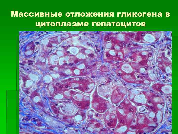 Массивные отложения гликогена в цитоплазме гепатоцитов 