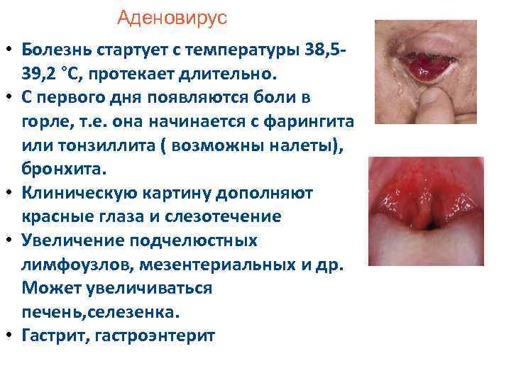 Аденовирус • Болезнь стартует с температуры 38, 539, 2 °С, протекает длительно. • С